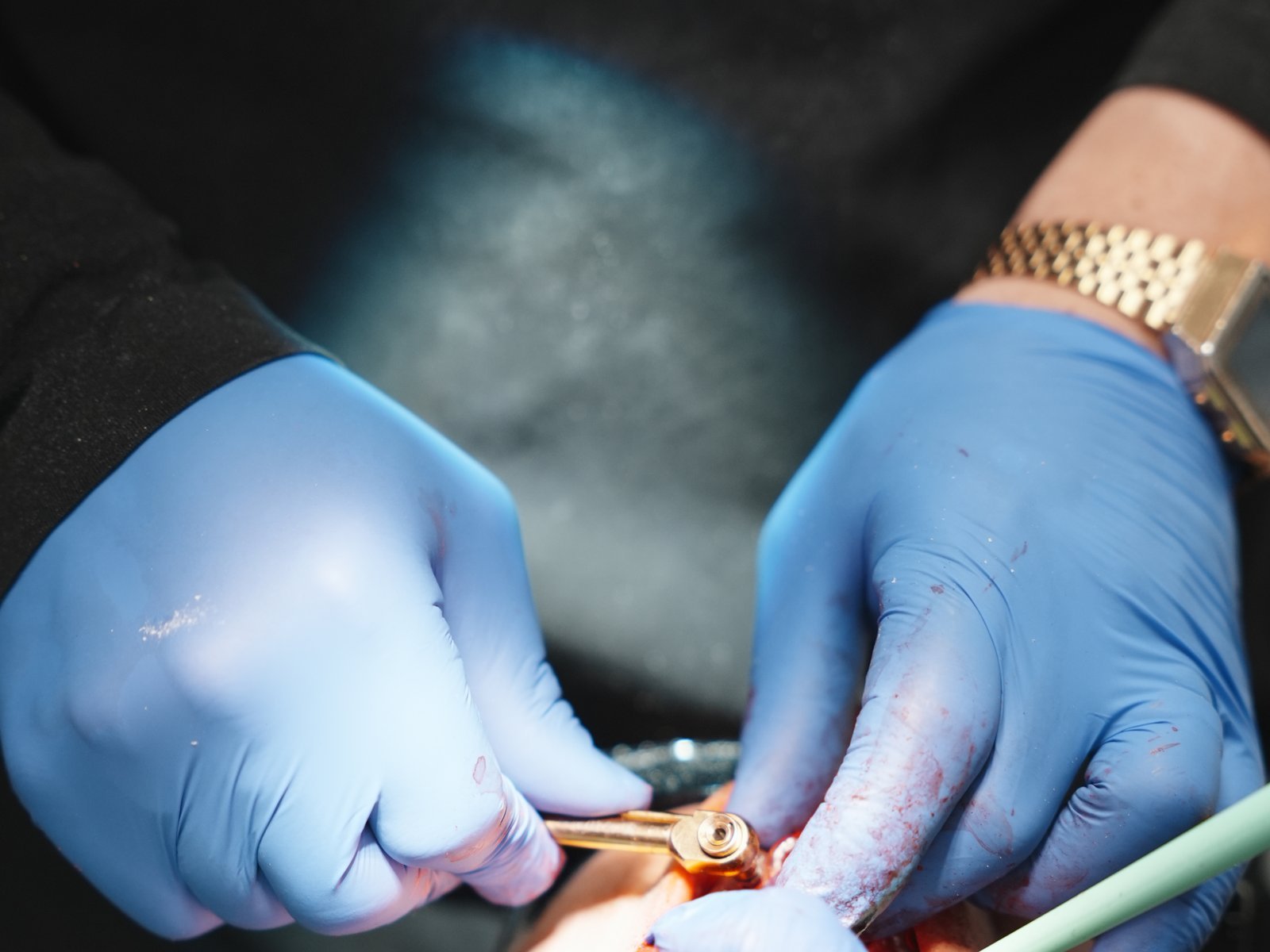 IV sedation procedure at Suncoast Dental