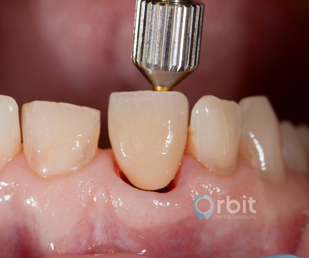 single crown implant tooth replacement front tooth goderich huron county implant dentist